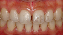 歯のステイン除去 お役立ち情報 オーラルケア サンスター製品情報サイト