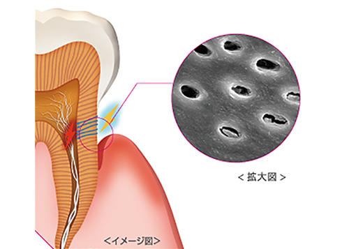 知覚過敏の原因は『知覚ホール*』にあり！
