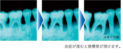 歯周病は、歯を支える骨まで溶かす『細菌感染症』です。最後には歯を支えられなくなり、歯が抜けてしまいます。