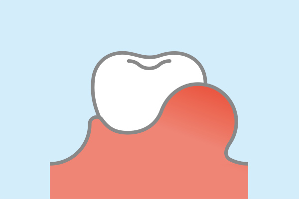 歯周病予防のためのおすすめ製品
