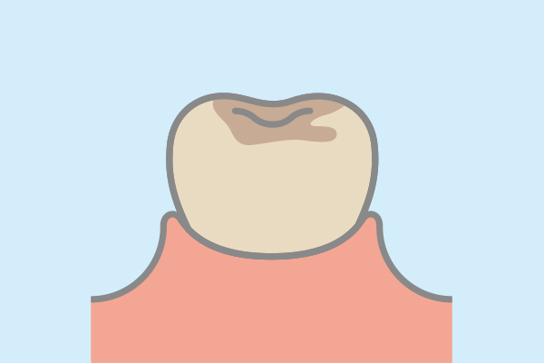 歯のステイン（着色 汚れ）除去